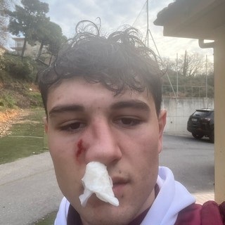 PONTELUNGO Duro comunicato dopo la gomitata subita da Garabello PONTELUNGO Duro comunicato dopo la gomitata subita da Garabello