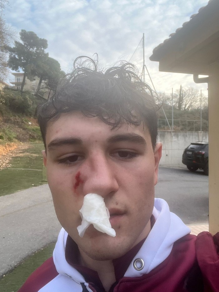 PONTELUNGO Duro comunicato dopo la gomitata subita da Garabello PONTELUNGO Duro comunicato dopo la gomitata subita da Garabello